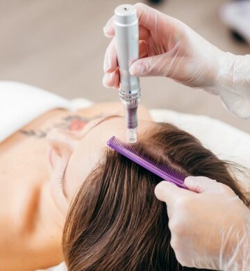 Mistrovská třída: mikrojehličková péče o alopecii
