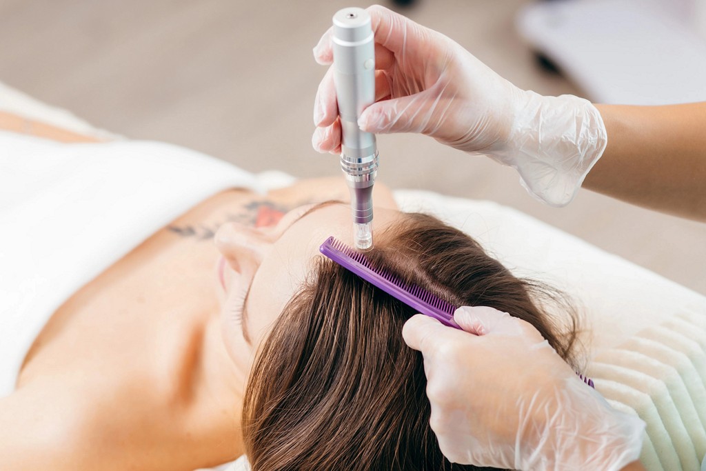 Mistrovská třída: mikrojehličková péče o alopecii